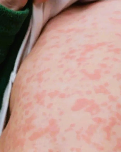 Ontario measles cases decline to zero in former outbreak zone